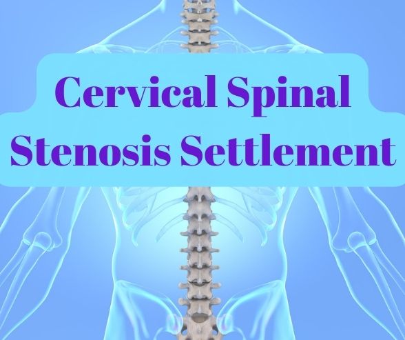 Cervical Spinal Stenosis Settlement