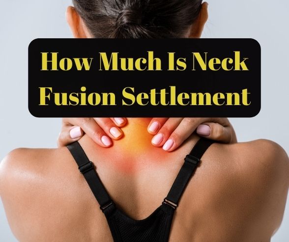How Much Is Neck Fusion Settlement
