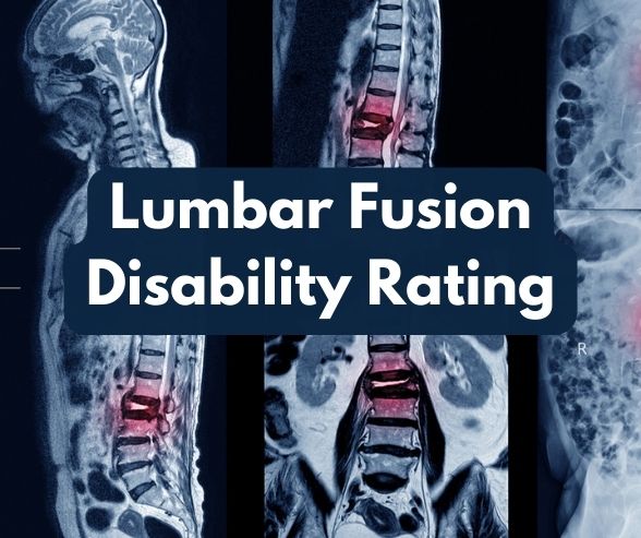 Lumbar Fusion Disability Rating