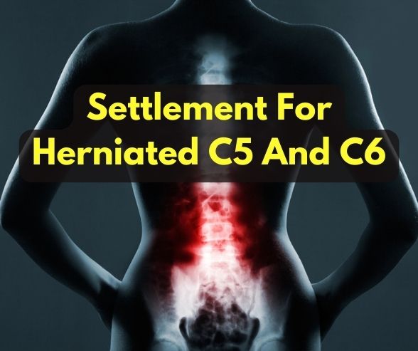 Settlement For Herniated C5 And C6